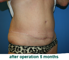 plastic-surgery-tummy-tuck